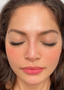 Nose and Chin Fillers