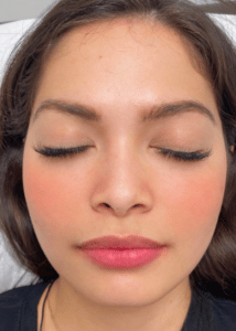 Nose and Chin Fillers