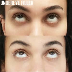 UndereyeFillerBA 300x300 1